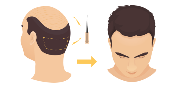 Hair Transplant Fethiye