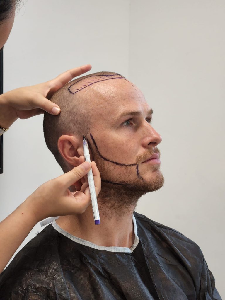 Hair Transplant with a Vacation in Antalya