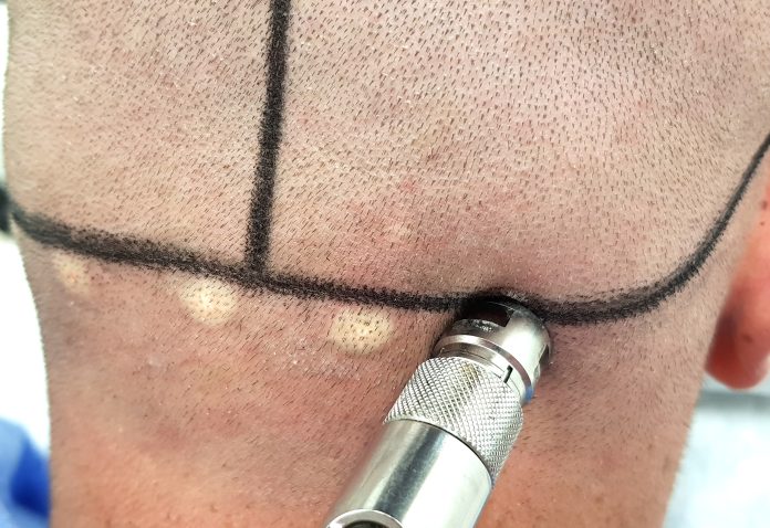 Pain-Free, Needle-Free Hair Transplant