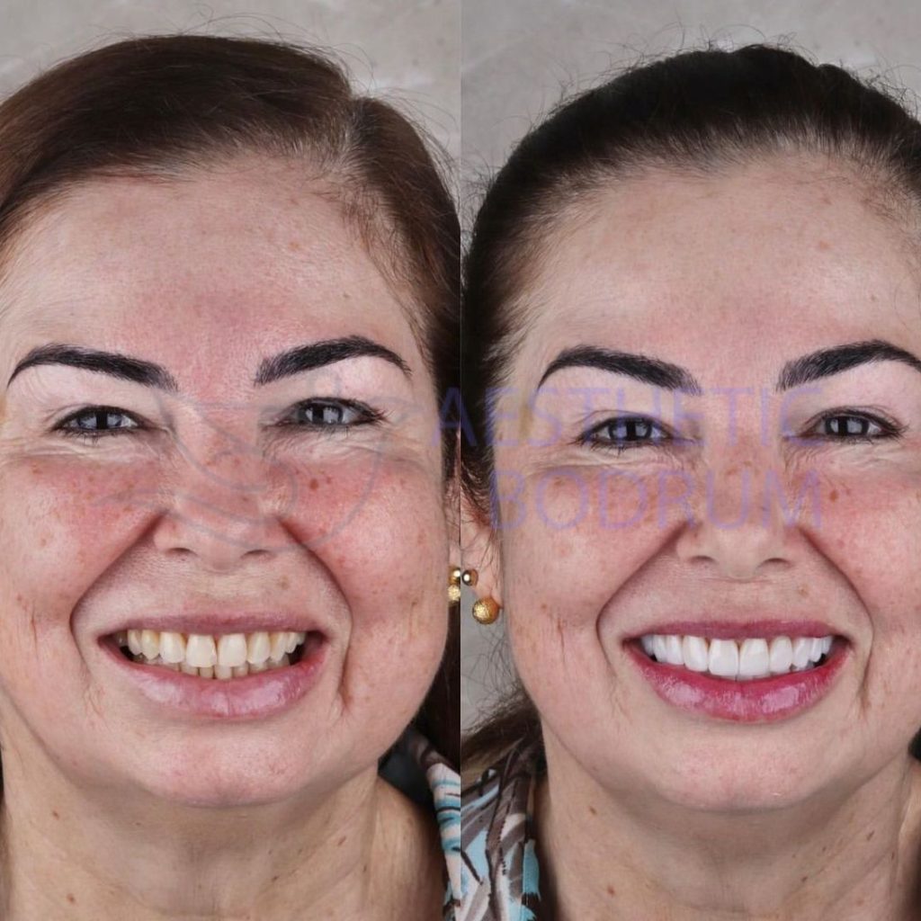 Bodrum Cosmetic Dentistry