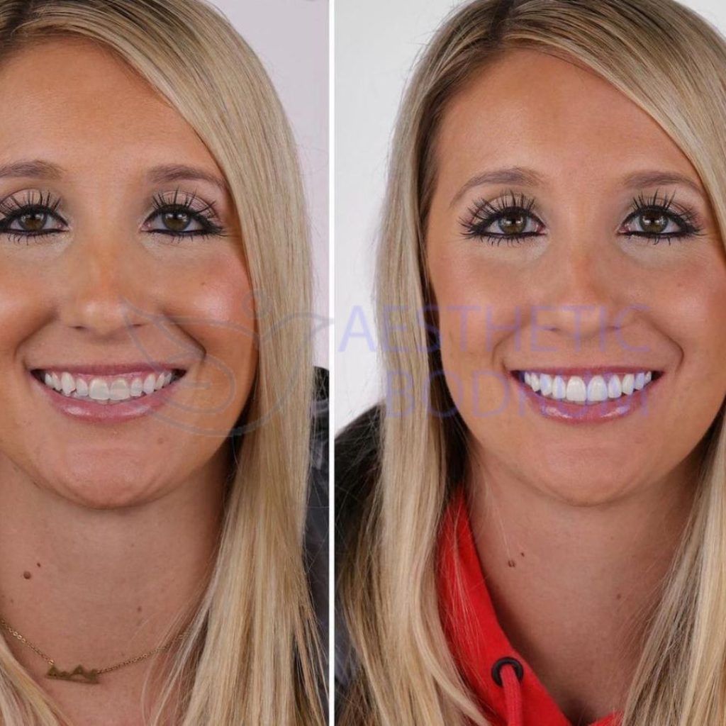 Bodrum Smile Makeover Before After