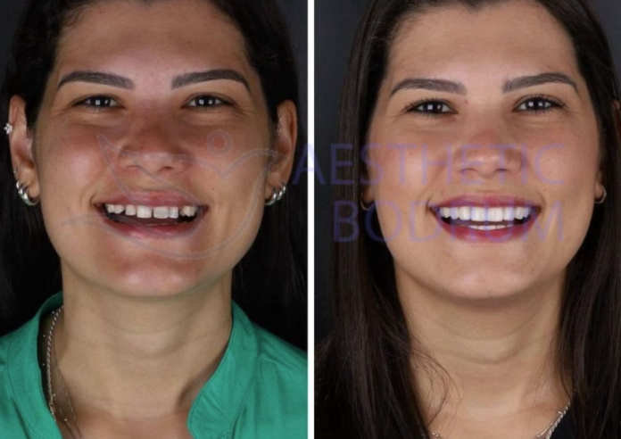 Bodrum Zirkonyum Kaplamalar görselinde modern estetik diş hekimliği uygulamaları, doğal beyaz gülüş tasarımı ve premium dental tedavi konsepti yer alıyor. Bodrum’da uygulanan zirkonyum diş kaplamaları sayesinde doğal görünümlü, dayanıklı ve estetik bir gülüş hedefleniyor. Modern diş kliniği, sağlıklı beyaz dişler ve dental turizm konsepti öne çıkarılıyor. Bodrum Zirkonyum Kaplamalar.
