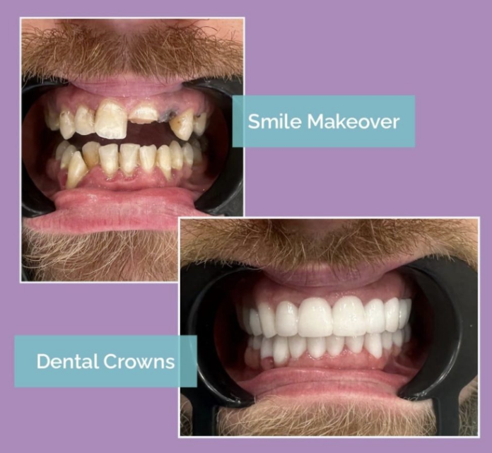 Bodrum’da dental crowns tedavisi ile zirkonyum kaplama, E-Max kaplama ve estetik diş restorasyonu yapılan modern dental klinik.