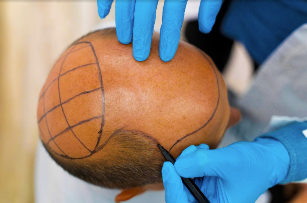 Kos to Bodrum: Year-Round Health Tourism with Tesla Travel – Hair Transplants, Dental Care, and Aesthetic Treatments