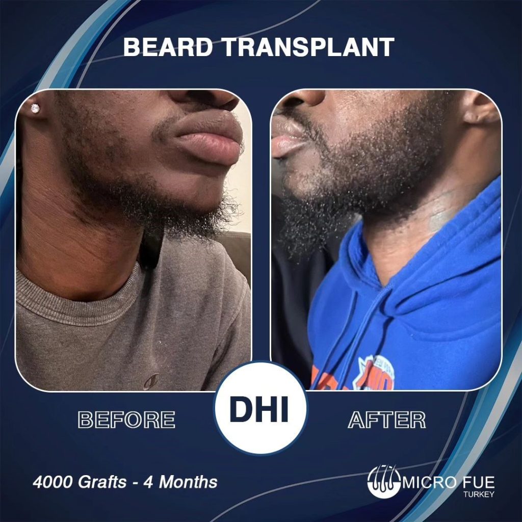 Beard Transplant in Bodrum