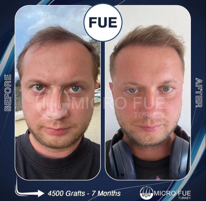 Hair Transplant Fethiye
