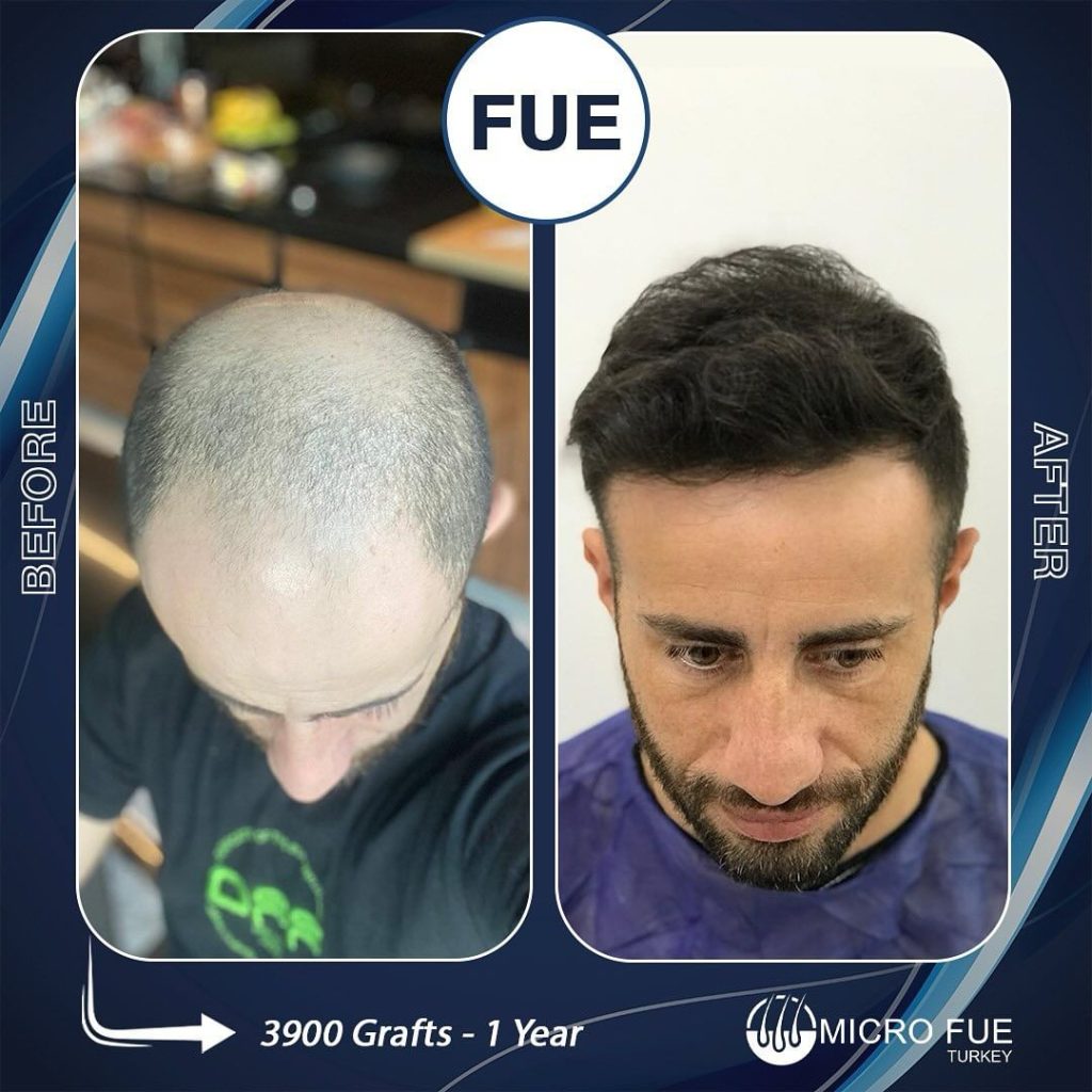 Hair Transplant in Kos