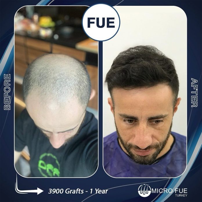 Hair Transplant in Kusadasi for Irish Tourists