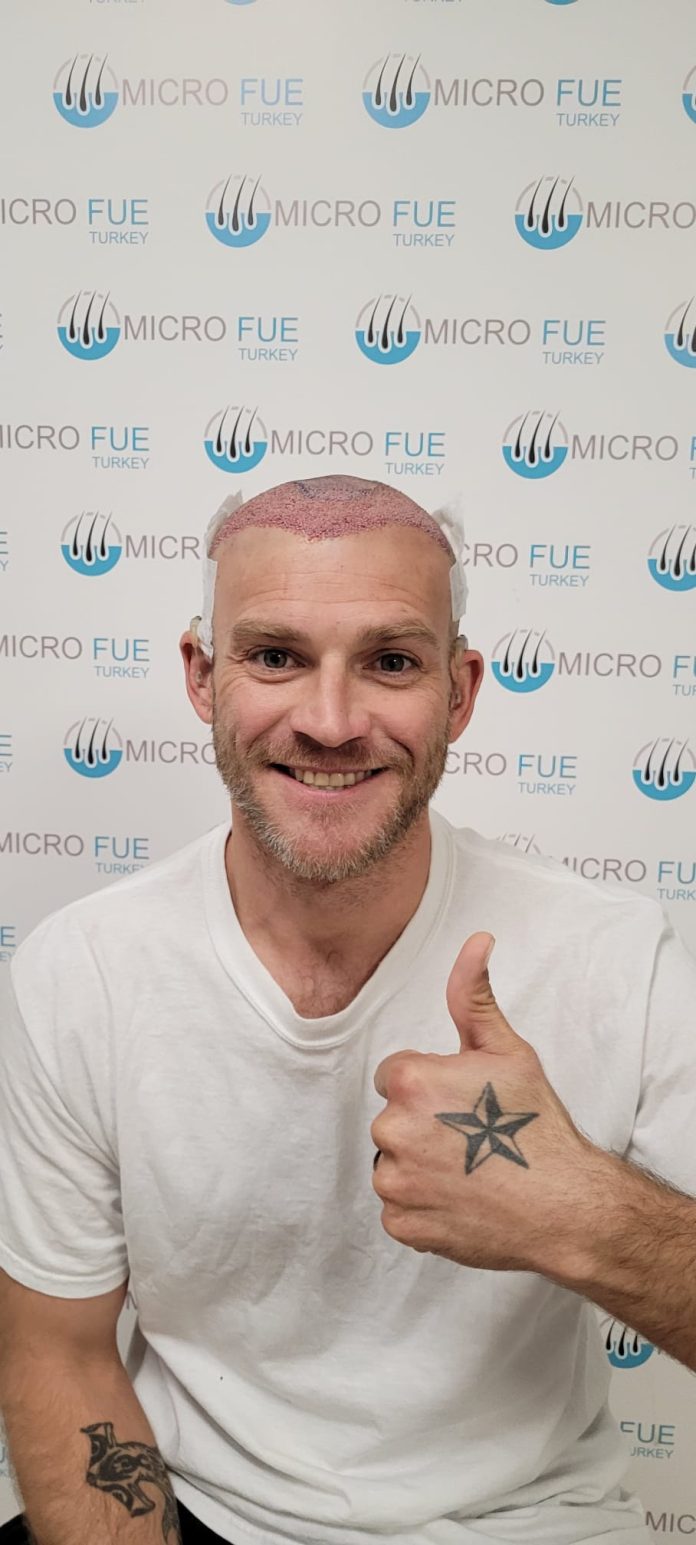Local Anesthesia for Hair Transplants