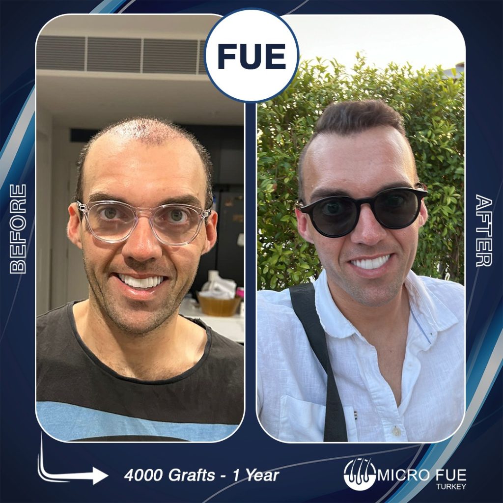 Beard Transplant in Bodrum Before After