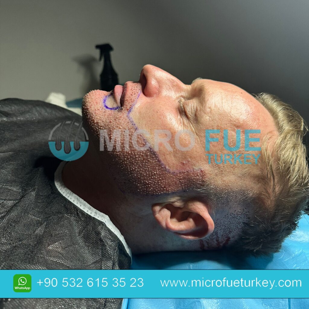 ALT TEXT: Saç Ekiminde PRP’nin Faydaları görselinde PRP tedavisi ile desteklenen modern saç ekimi uygulamaları yer alıyor. Türkiye’de saç ekimi sırasında uygulanan PRP Hair Treatment sayesinde saç köklerinin güçlenmesi, iyileşme sürecinin hızlanması ve daha sağlıklı saç büyümesi hedefleniyor. Klinik ortamı, saç ekimi uzmanı, PRP uygulaması ve doğal saç görünümü modern medikal tasarım ile sunuluyor. Saç Ekiminde PRP’nin Faydaları: Türkiye’de Saç Ekimi Yaptırmadan Önce Bilmeniz Gerekenler.