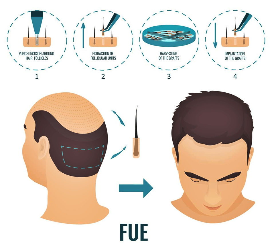 Hair Transplant in Izmir