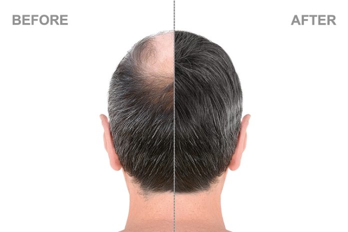 DHI Hair Transplant in Antalya