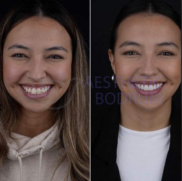 20 Emax Veneers in Bodrum