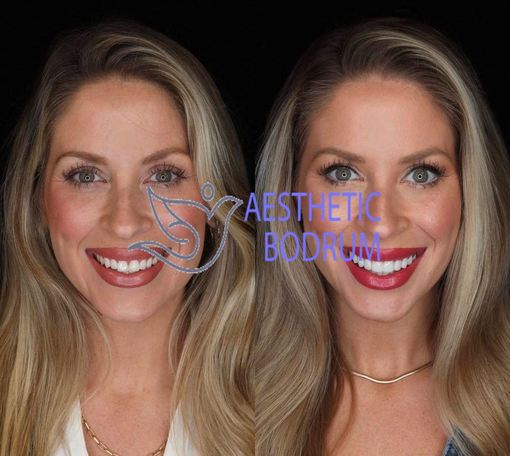 Dentist in Kos Before After