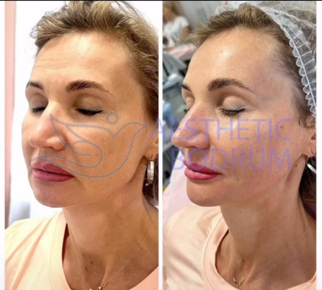 Botox in Marmaris