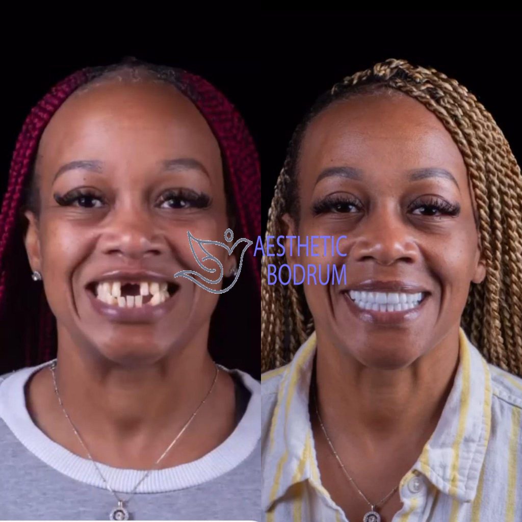 Dentist in Kos Before After