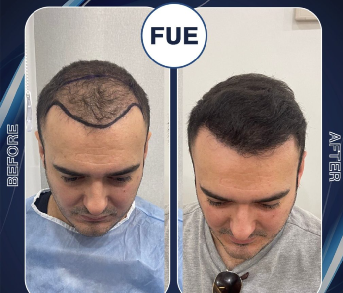 TÜRKİYE'DE SAÇ EKİMİ KLİNİĞİ
