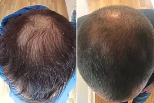 Regenera Activa Hair Transplant in İstanbul and Antalya