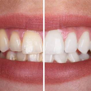 Teeth Whitening in Rhodes