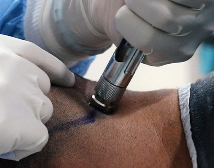 Local Anesthesia in Hair Transplants