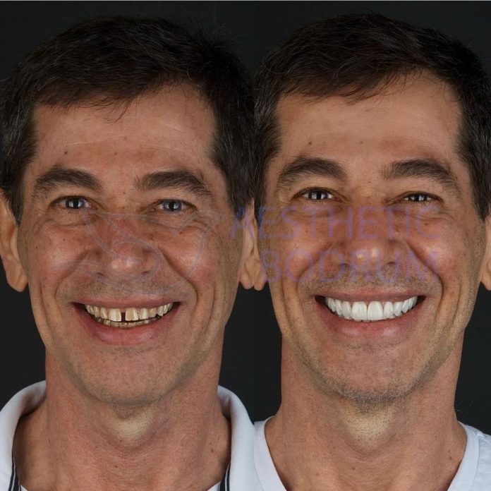 Bodrum Smile Makeover