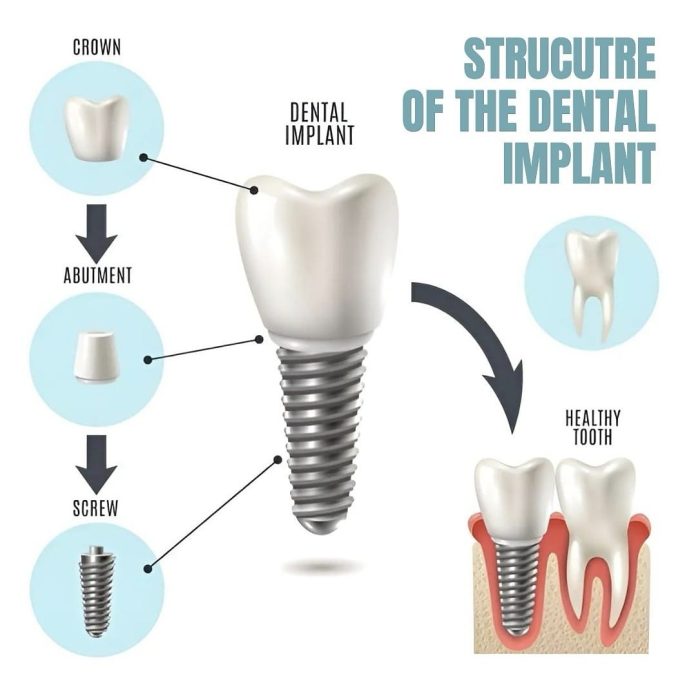 Dental Implants in Bodrum