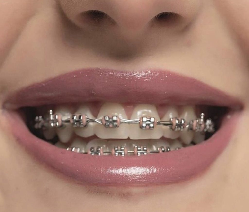 Comparing Winter and Summer Dental Implant Travel in Bodrum