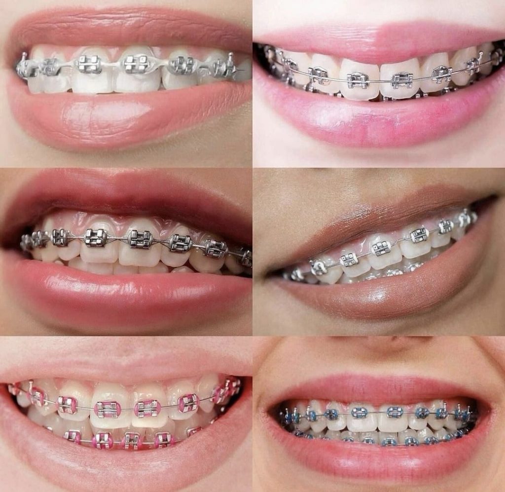 Bodrum Orthodontics Before After