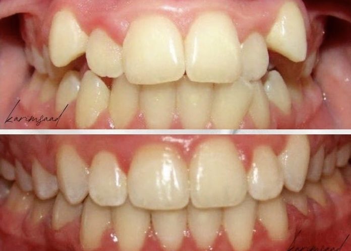 Bodrum Smile Makeover