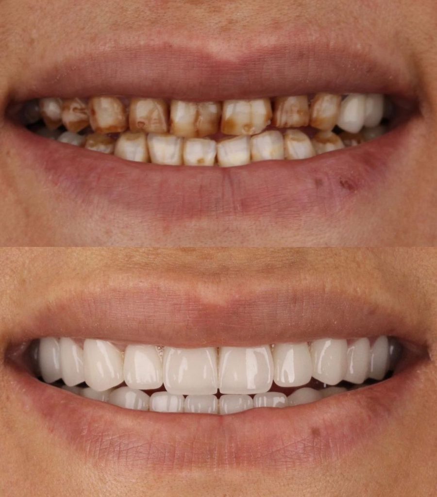 Bodrum Dental Veneers Before After