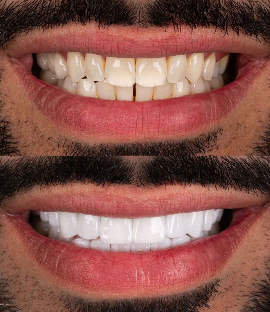 Bodrum Dental Veneers Before After