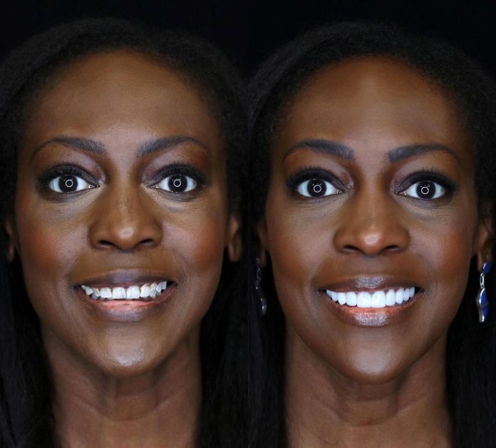 Hollywood Smile in Bodrum