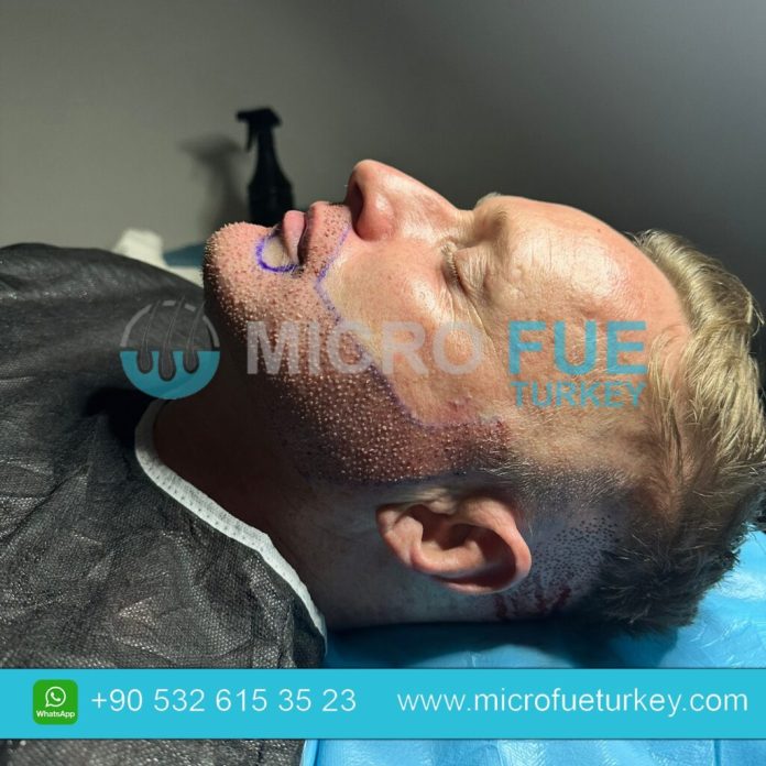 PRP in Hair Transplant