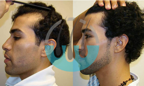 FUE Hair Transplant Antalya Before And After