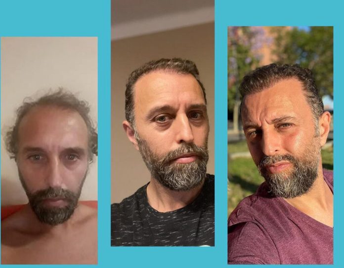 Hair Transplant Bodrum