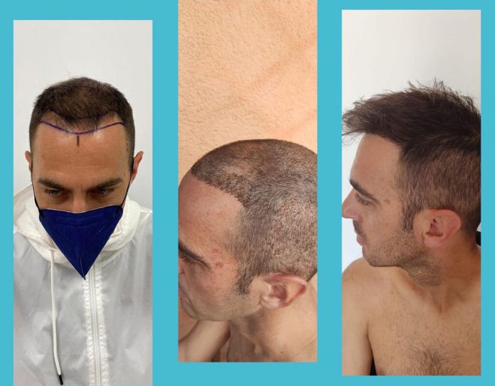 Hair Transplant Pricing in Turkey vs. The United States