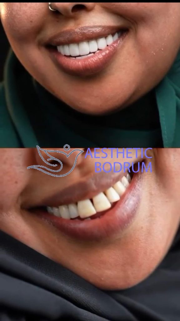20 Zirconium Crown in Bodrum