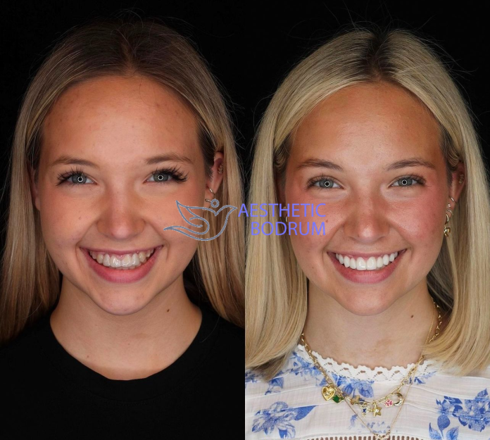 20 Emax Veneer in Bodrum