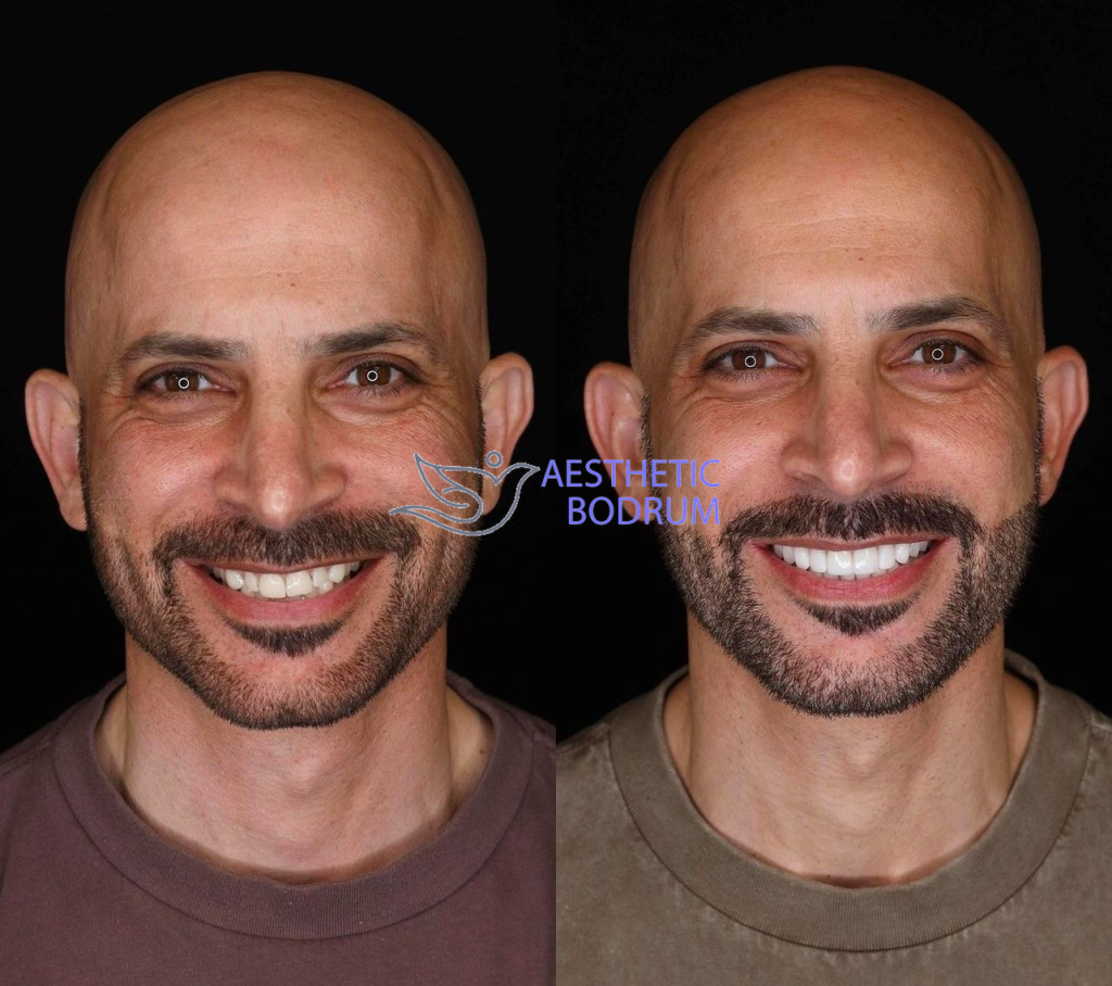 Veneer Transformation