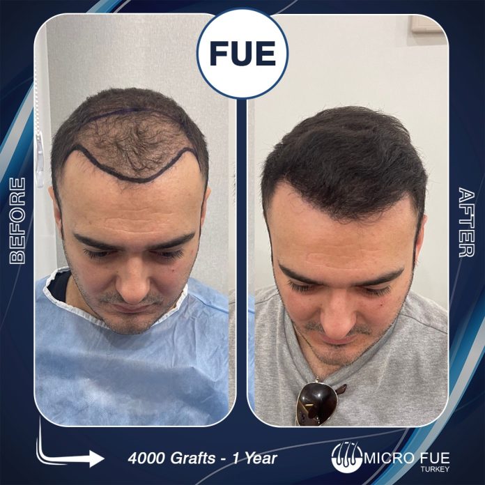 Hair Transplant in Turkey