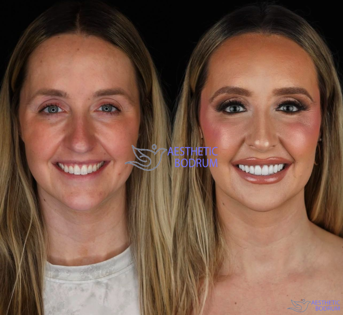 Teeth Whitening in Didim
