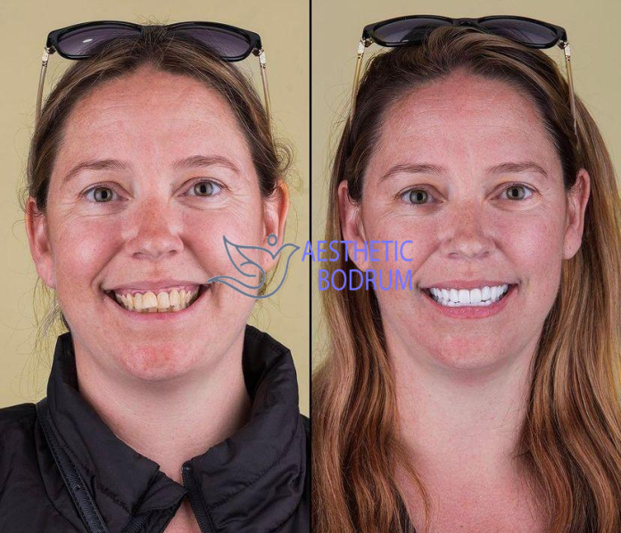 Teeth Cleaning in Didim