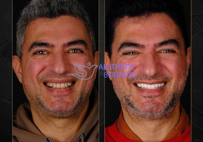 Teeth Cleaning and Whitening in Bodrum Before After
