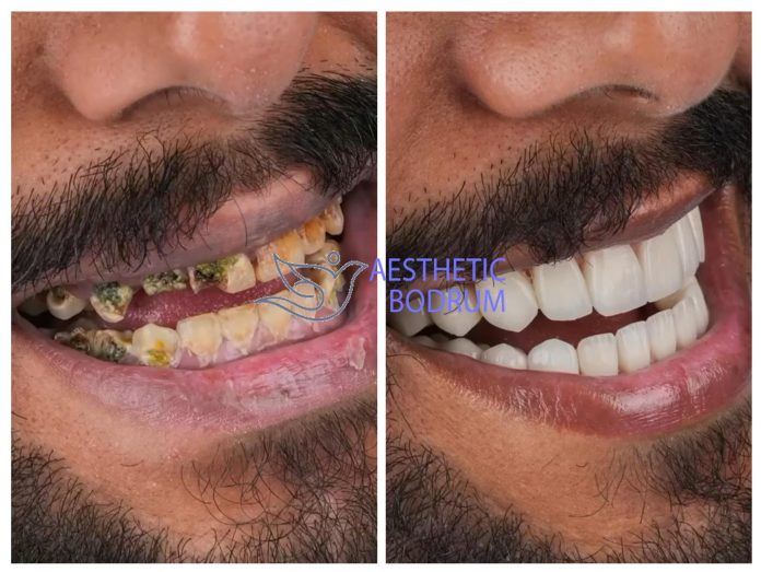 10 Implant in Bodrum Before After