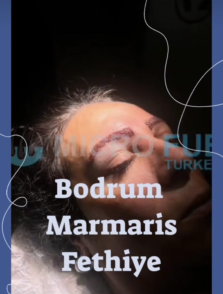 Eyebrow Transplant in Turkey