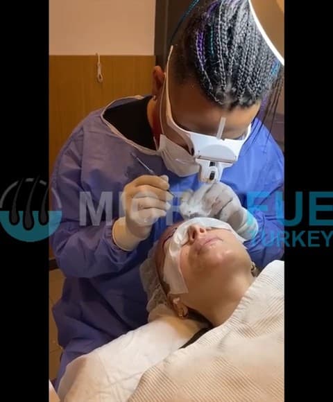 Eyebrow Transplant in Turkey