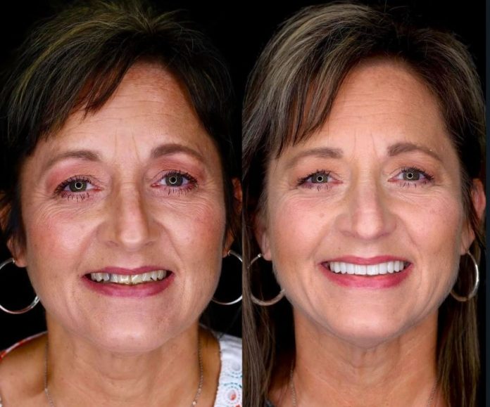 2 Implant 20 Emax Veneer 2 Zirconium in Bodrum Before After