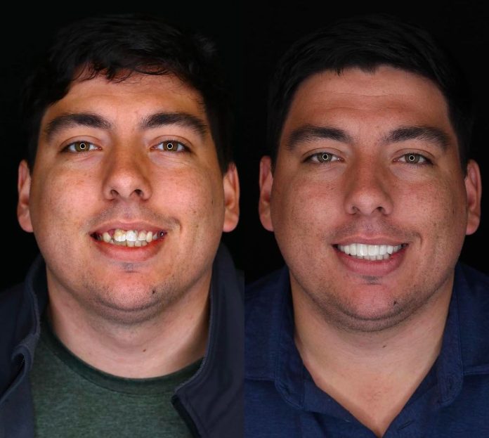 Teeth Whitening in Samos