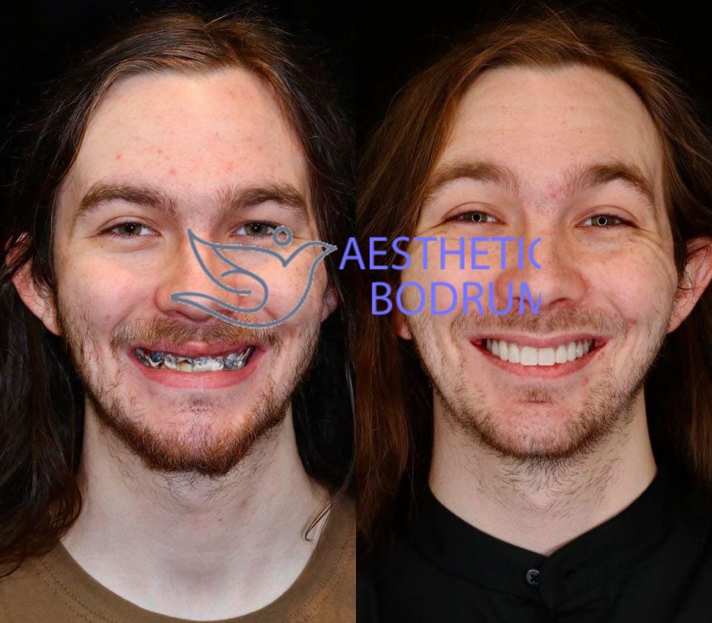 8 Implant 24 Zirconium in Bodrum